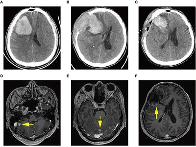 Intracerebral Hemorrhage as the Initial Presentation of Chronic Myeloid Leukemia: A Case Report and Review of the Literature